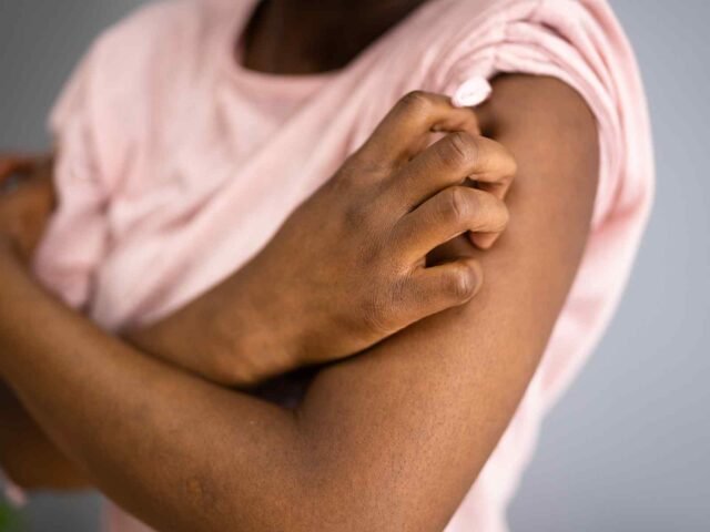 How Should You Treat Seborrheic Dermatitis How Should You Treat Seborrheic Dermatitis