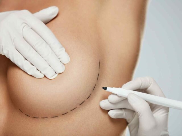 What to do After Breast Augmentation Surgery in Vivo What to do After Breast Augmentation Surgery in Vivo