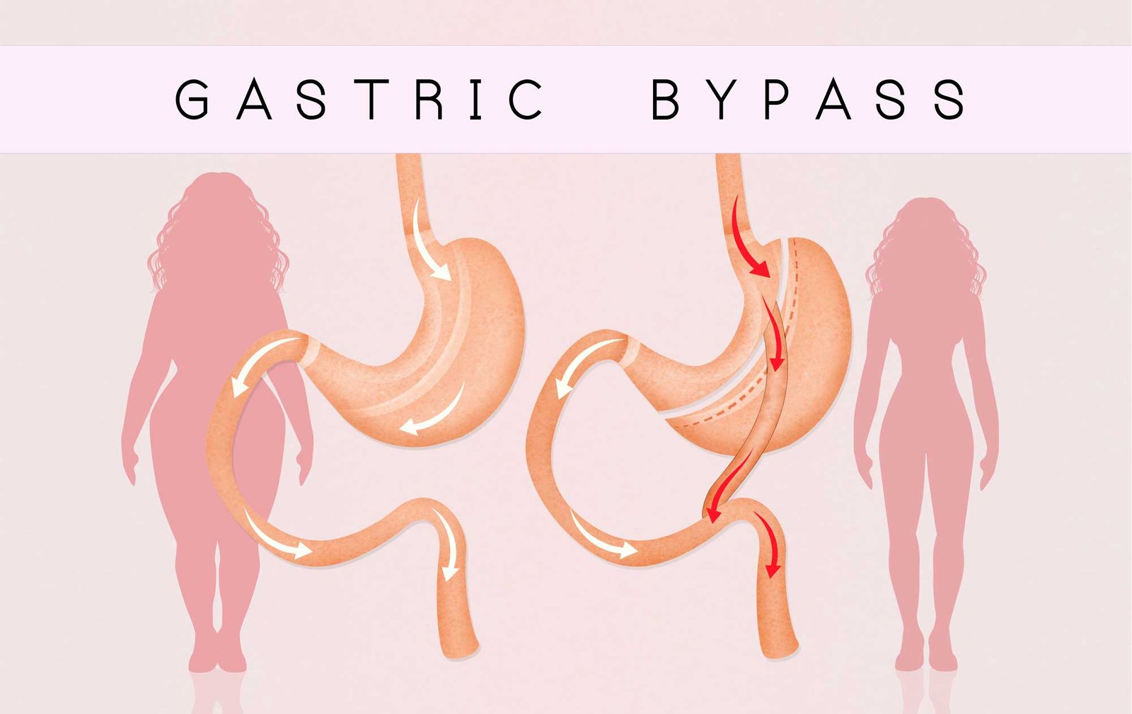 https://clinoraclinic.ghayatltd.com/wp-content/uploads/2026/06/Gastric-Bypass-Banner.jpg