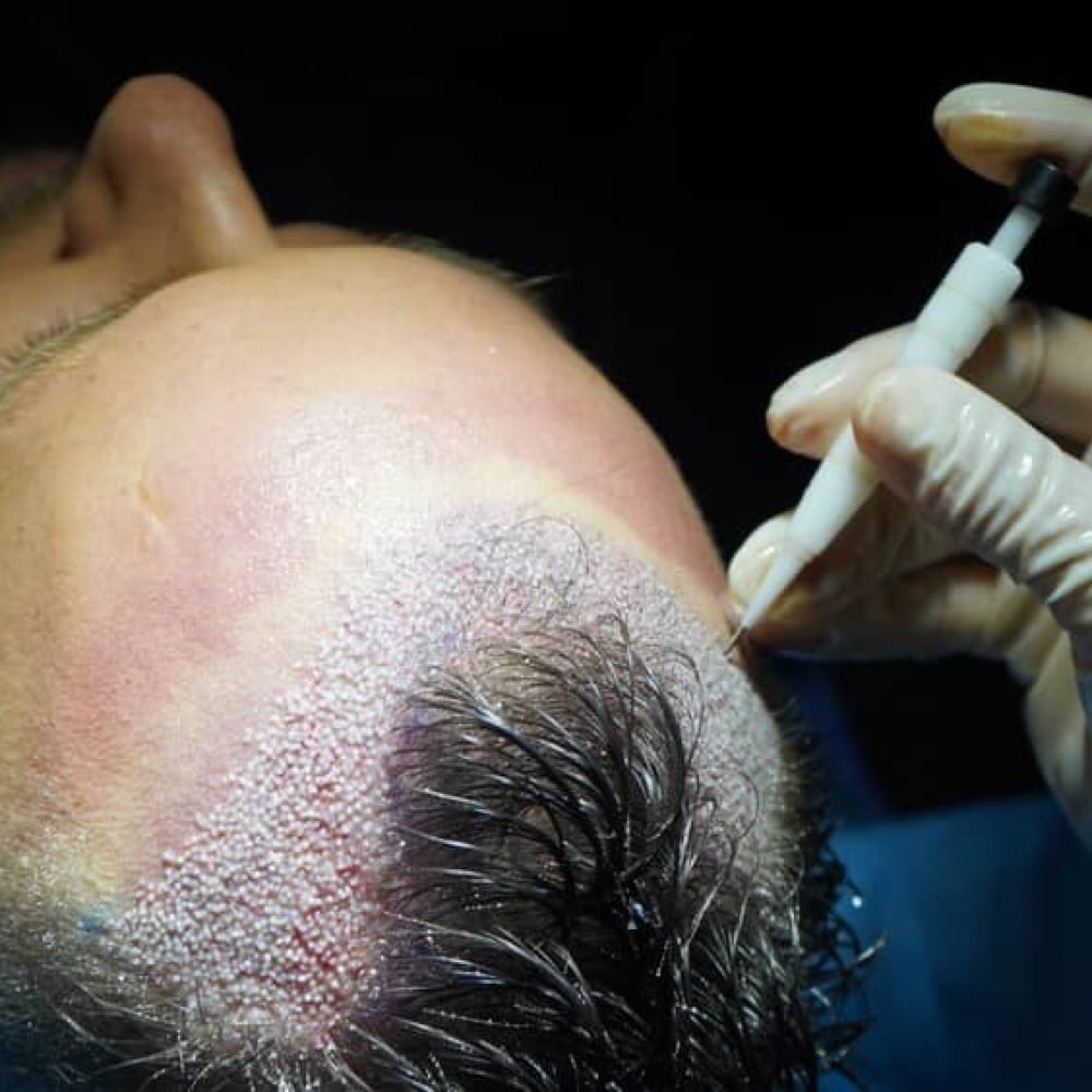 https://clinoraclinic.ghayatltd.com/wp-content/uploads/2026/06/dhi-hair-transplant-operation-1-pr2zfw0ippjls509rzasej7786l9bue5h8hktvmzo0.jpg