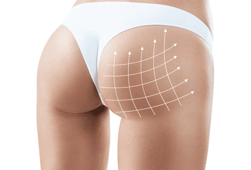 https://clinoraclinic.ghayatltd.com/wp-content/uploads/2026/06/materials/bbl/brazillian_butt_lift_procedure.webp