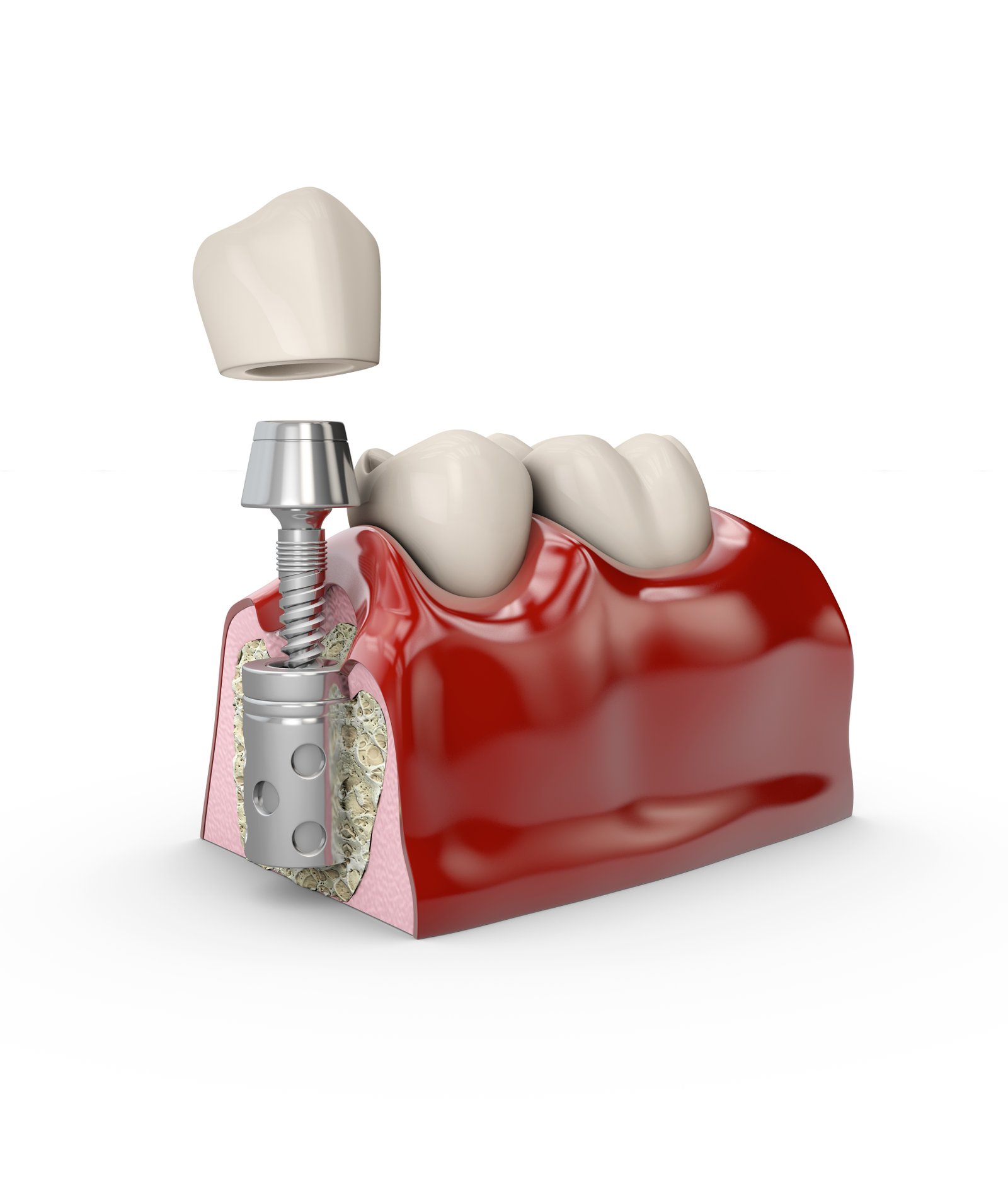 https://clinoraclinic.ghayatltd.com/wp-content/uploads/2026/06/materials/dental-imp/shutterstock_1230831121.jpg