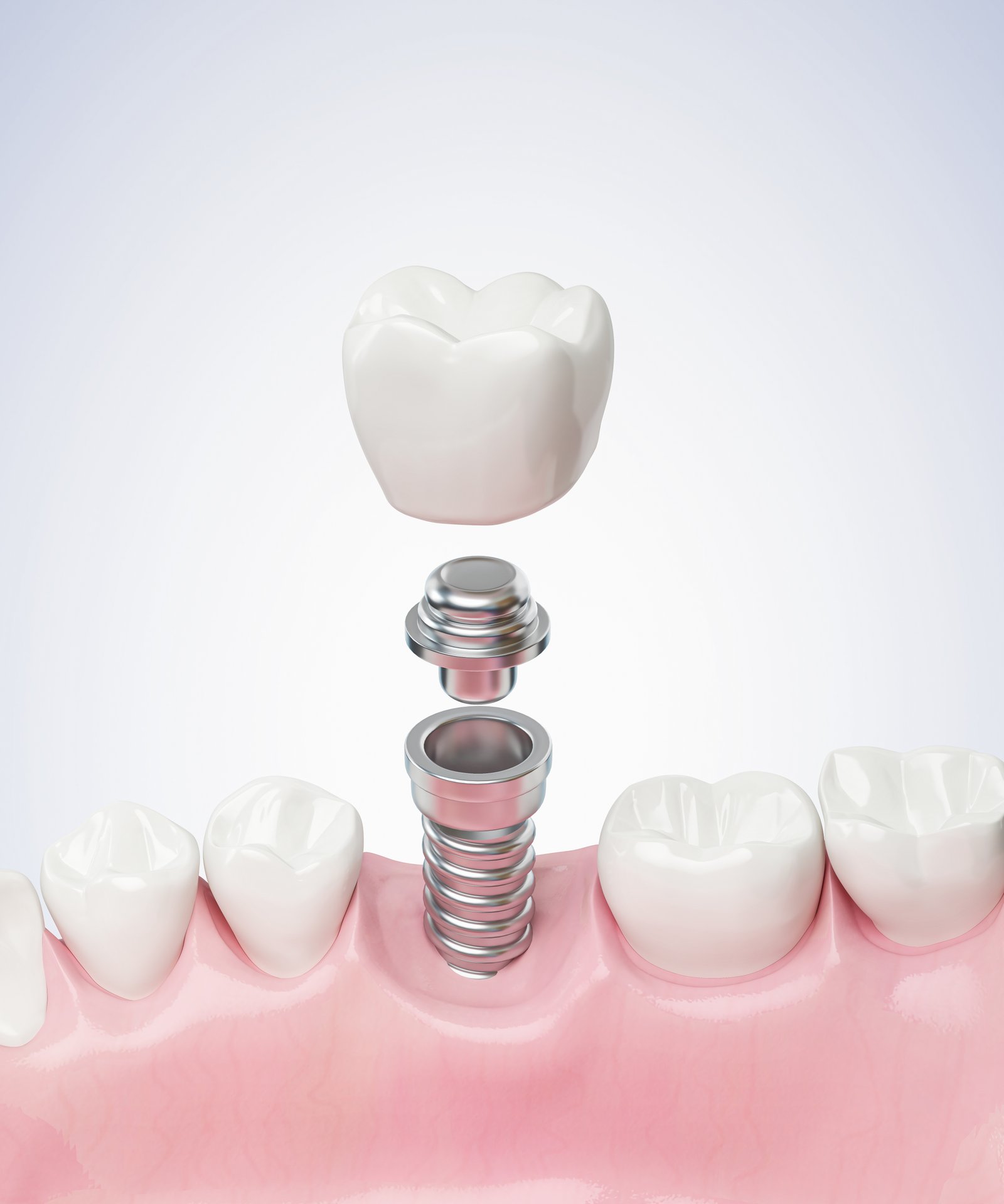 https://clinoraclinic.ghayatltd.com/wp-content/uploads/2026/06/materials/dental-imp/shutterstock_2246674343.jpg