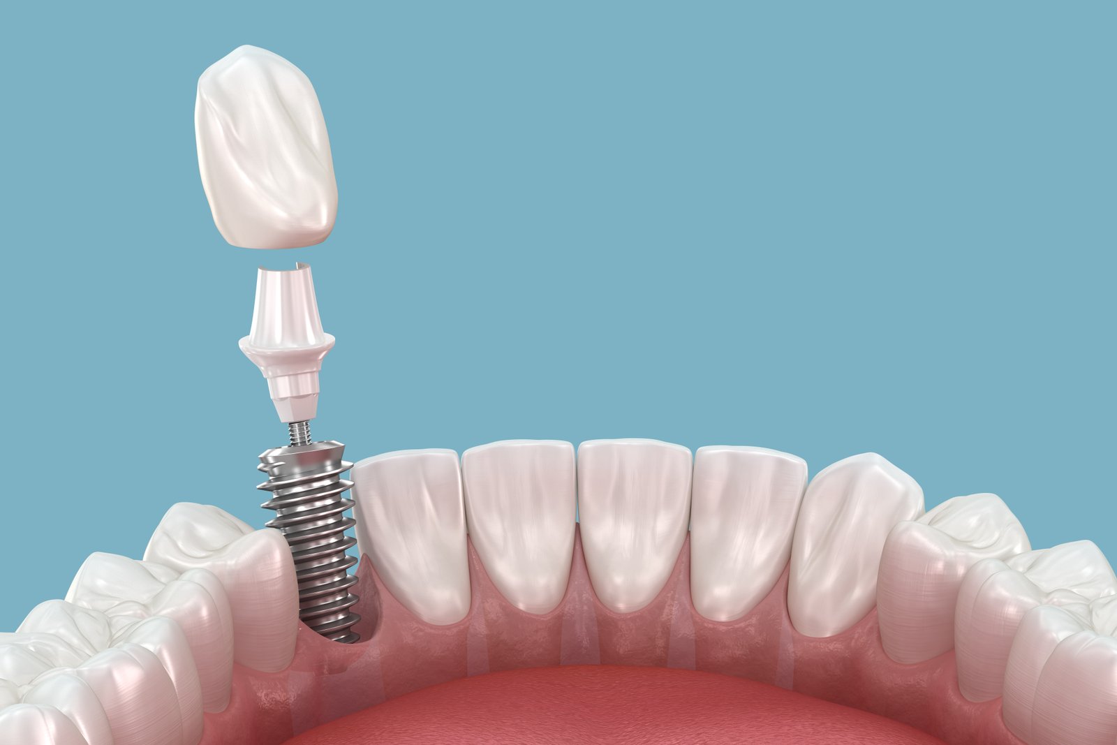 https://clinoraclinic.ghayatltd.com/wp-content/uploads/2026/06/materials/dental-imp/shutterstock_2344703961.jpg