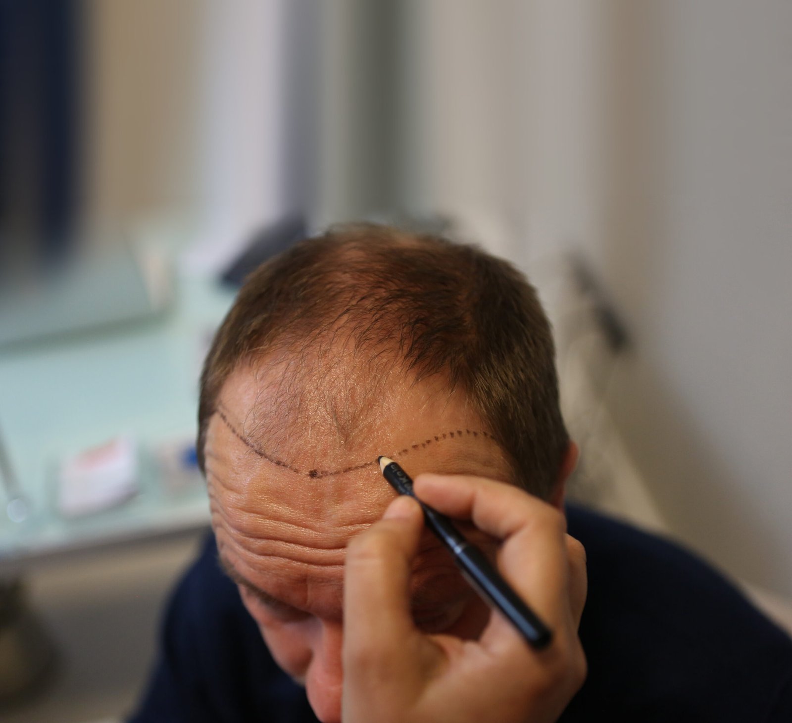 4 December 2014. Istanbul.Turkey. Hair transplantation is a surgical technique that moves hair follicles from a part of the body.