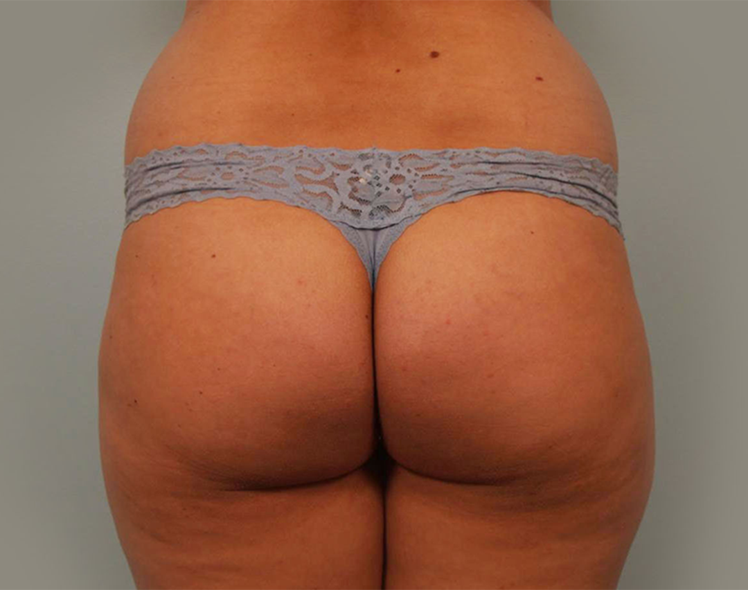 <span class="bt_bb_before_after_image_after_text">After</span>