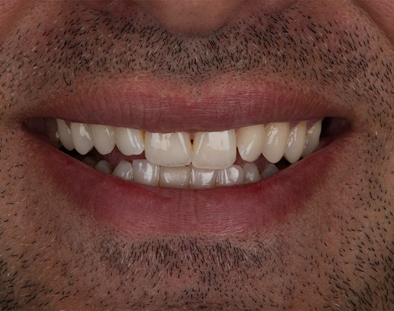 <span class="bt_bb_before_after_image_before_text">Before</span>