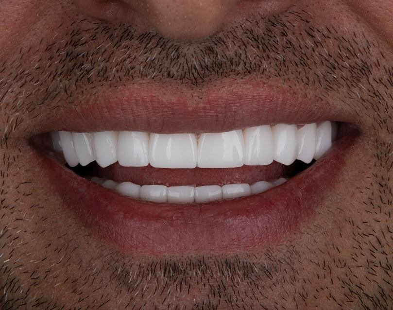 <span class="bt_bb_before_after_image_after_text">After</span>