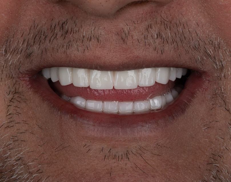 <span class="bt_bb_before_after_image_after_text">After</span>